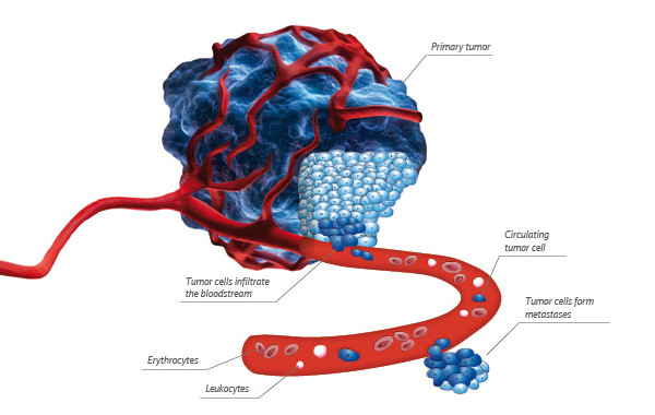 Primary tumor and the circulating tumor cells in the blood